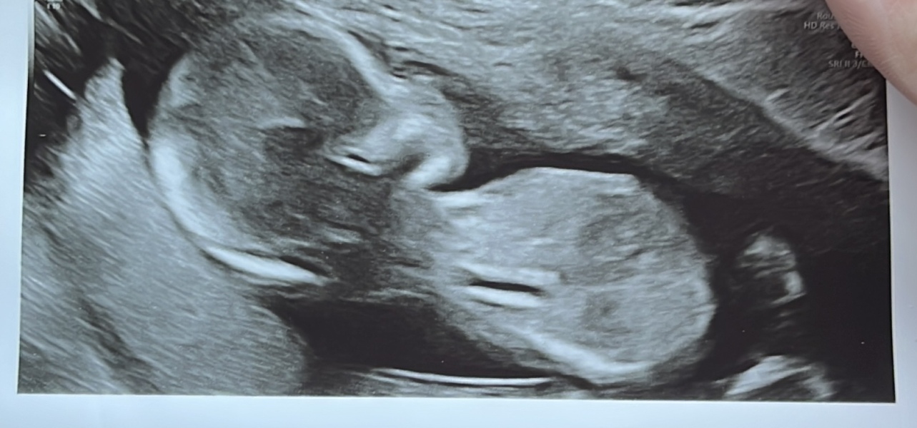 Nub theory boy or girl? 14+6