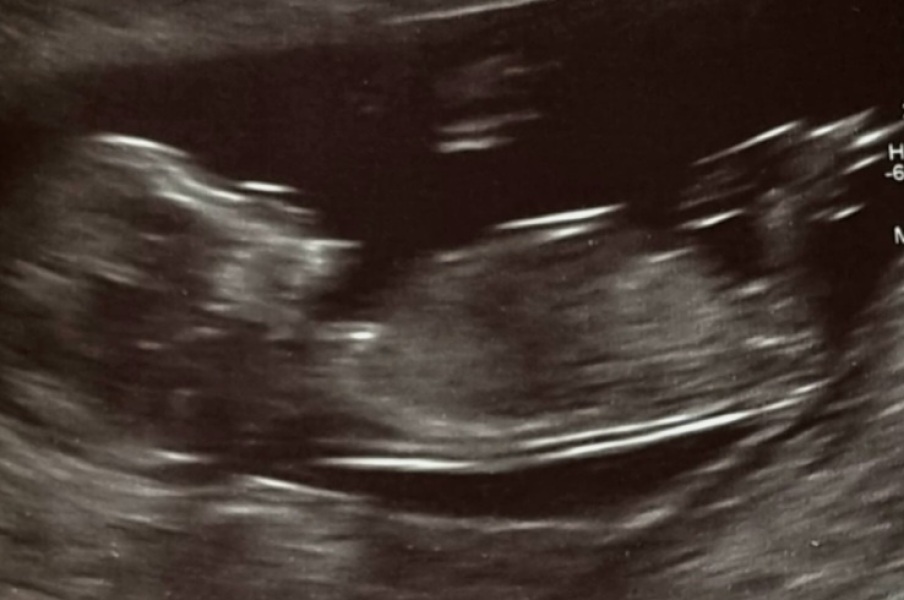 👶🏻 boy or girl? 👶🏻 Guesses please 🙏 I will update on Sunday 😊