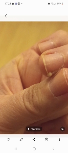 Why won't my goddam finger heal!