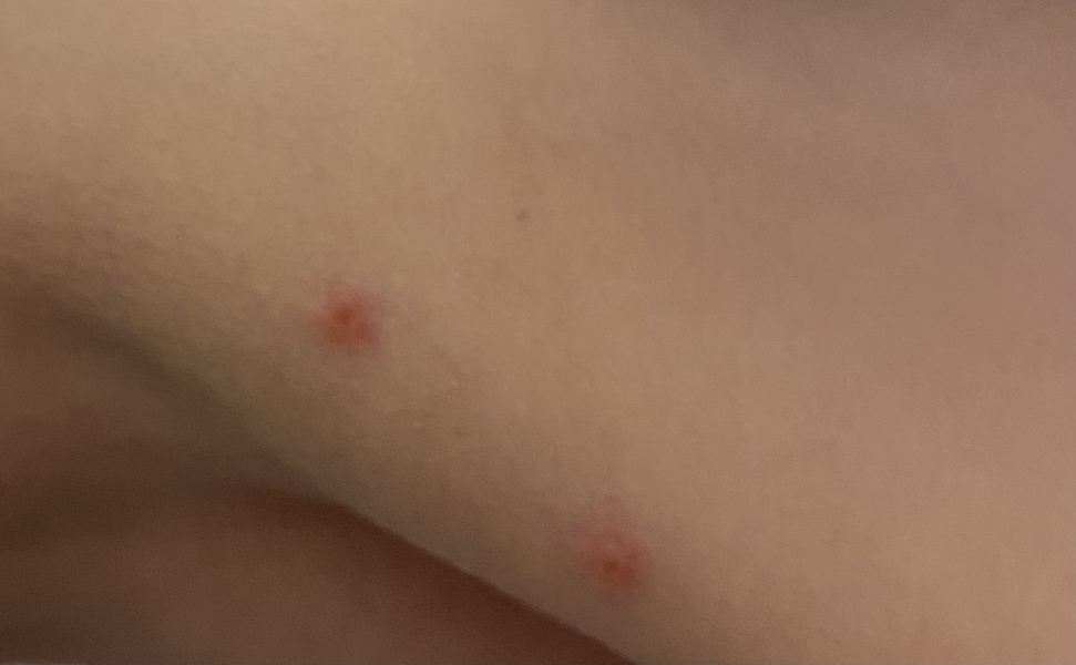 Chickenpox?