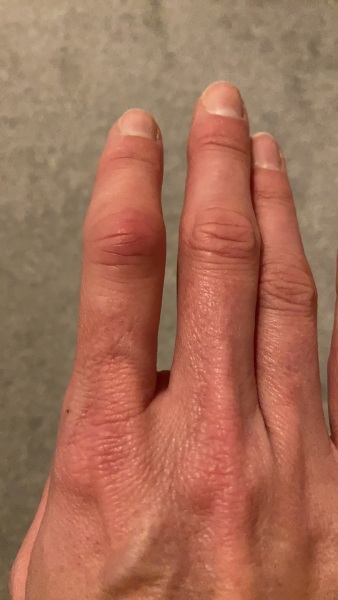 Is this a chilblain?