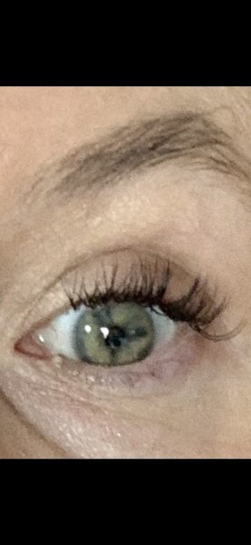What are these white lumps under my eye and is it possible to remove them?