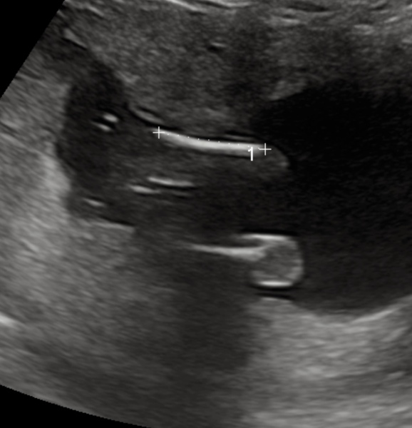 Gender scan - boy or girl?? 😁