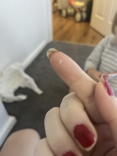 Threadworms and thumb sucking