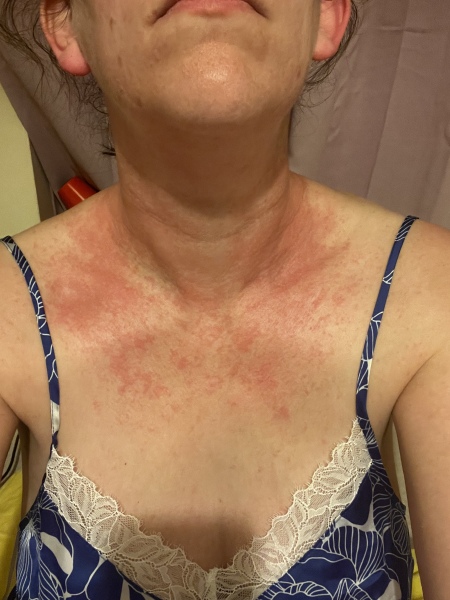 Please help, allergic reaction/scarlet fever or something else. 