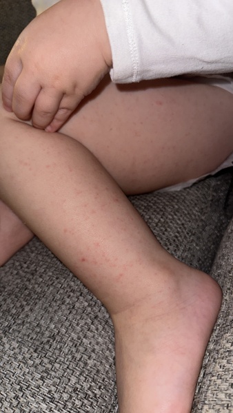 Rash