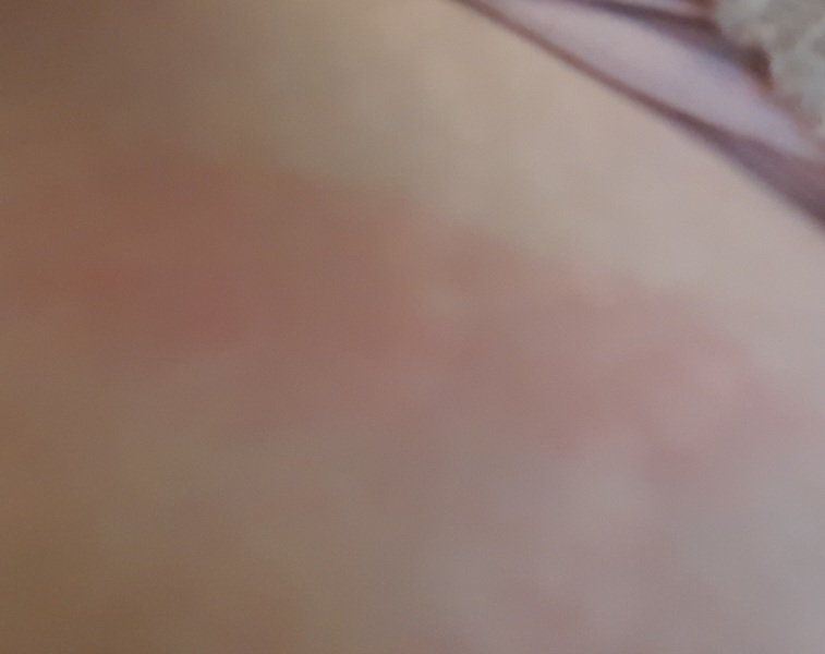 Red patches from fragmin - photos