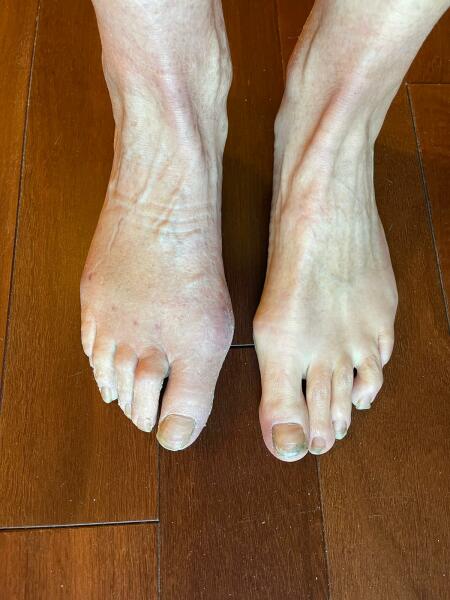 Post op bunion removal