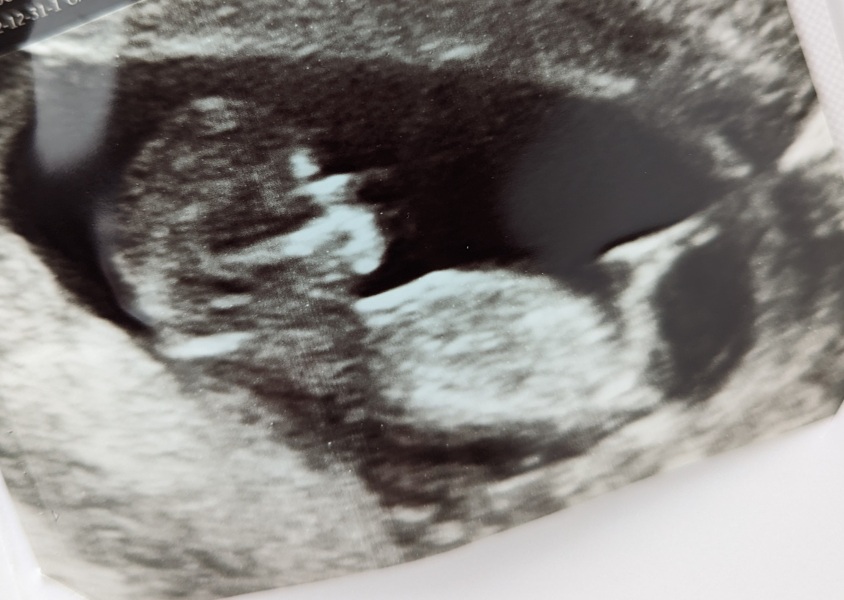 IVF warriors - journey continues