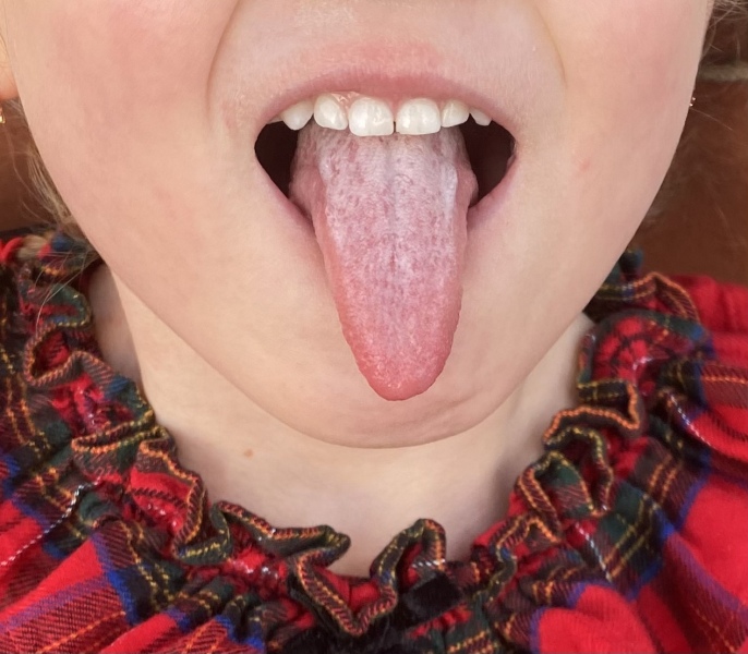 Is this strep?