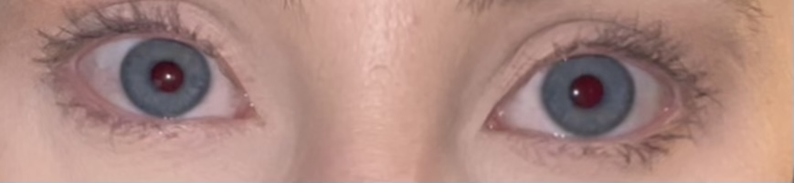 Is this a squint? Double vision? 