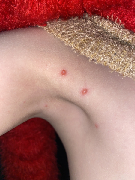 Chickenpox?