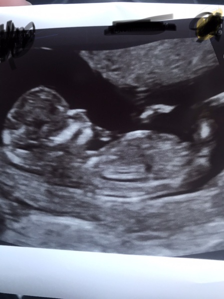Nub theory? It's a boy isn't it!