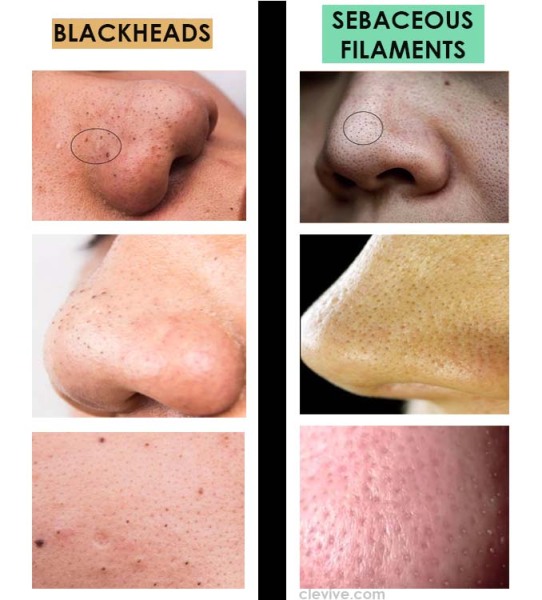 Blackheads 