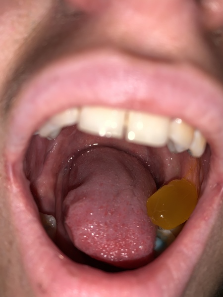 Strep A infection 
