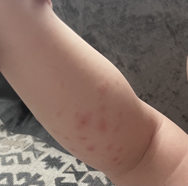 Hand, foot and mouth? 