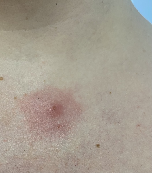 What is this on my chest?