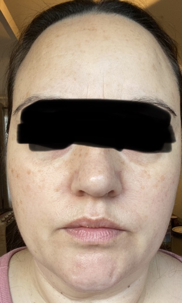 Please Help my face!