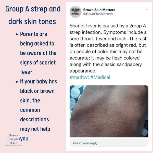 Info on Group A Strep/scarlet fever