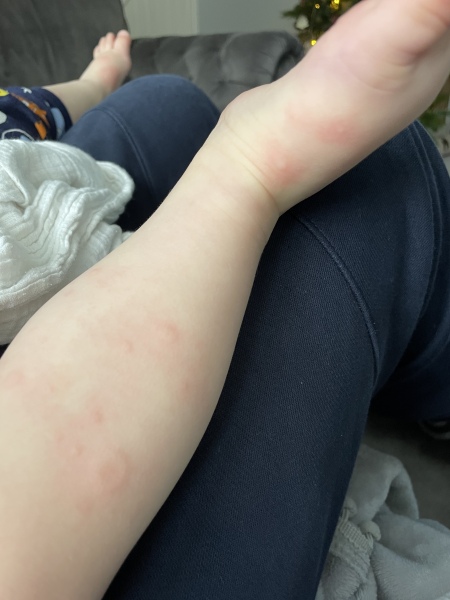 Chickenpox? 