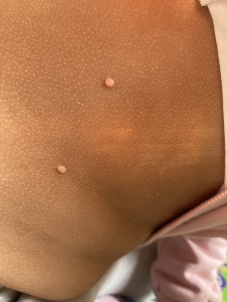 Though these were warts…what on earth are they?!