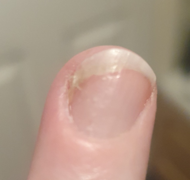 psoriatic arthritis- what were your early symptoms