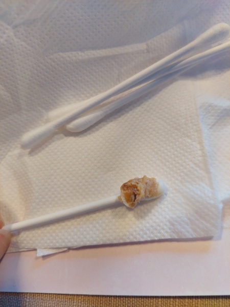 Me again with ear wax - picture