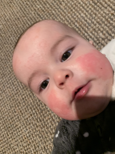 Baby rash! Has anyone experienced this? Pls help