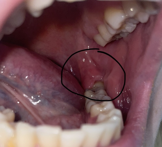 What is happening in my mouth?! Do I need a dentist? (Sorry for pic!)