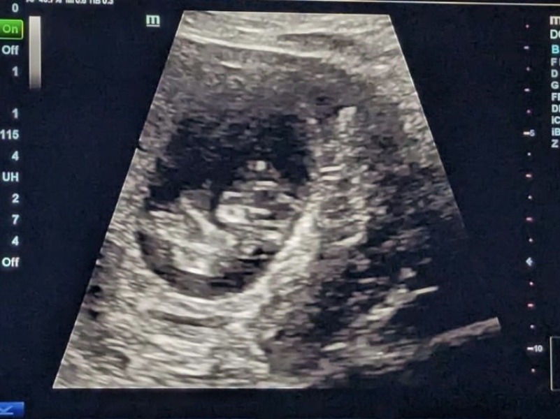 Short luteal phase?