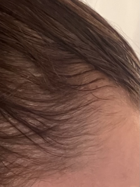 Is this thin hair or am I going bald ? Have a look at the pics 