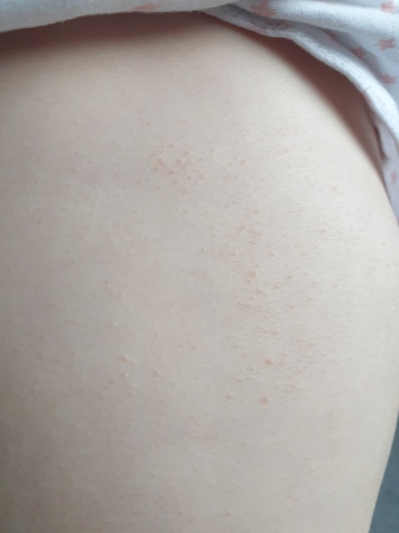 Help with identifying rash? Worried? SF?!