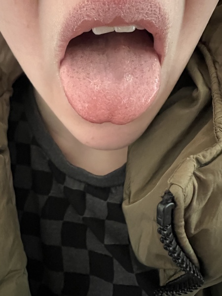 Strawberry tongue?
