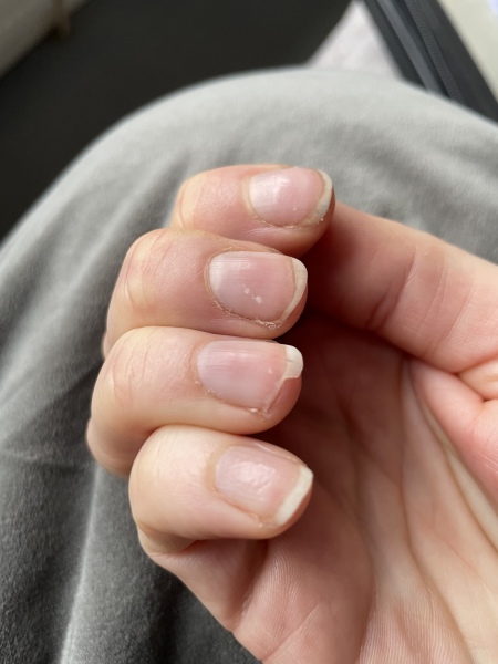 psoriatic arthritis- what were your early symptoms