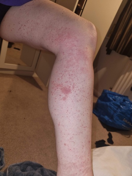 Rash after virus | Mumsnet