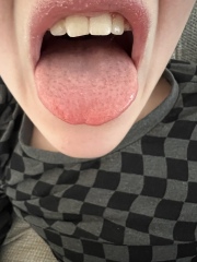 Strawberry tongue?