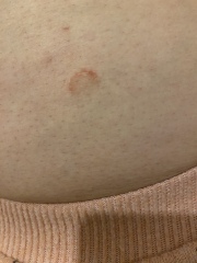 Ringworm or something else?