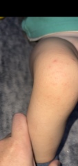 Fast spreading rash and irritability in my 1 year old