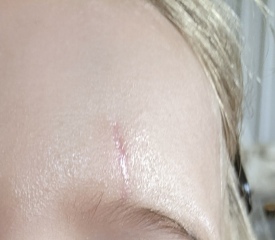 Help! Scar on my LO's face