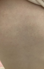 Strep A rash
