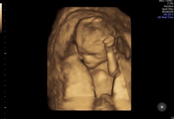 Very early pregnancy and so much anxiety after miscarriage