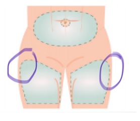 Refusing Clexane after C section 