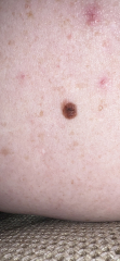 Melanoma what next?