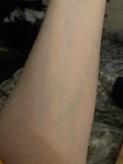 Very visible veins - Photo attached