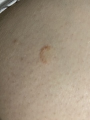Could this be ringworm? 