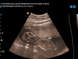 Does this look like low amniotic fluid?