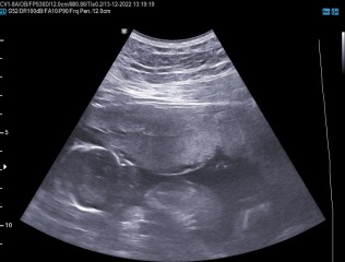 Does this look like low amniotic fluid?