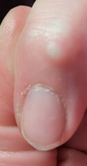 What's this growing on my finger? 