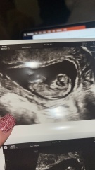 Pregnant after ivf - 5 weeks 