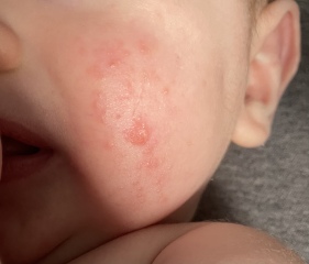 Rash/spots on baby cheeks???